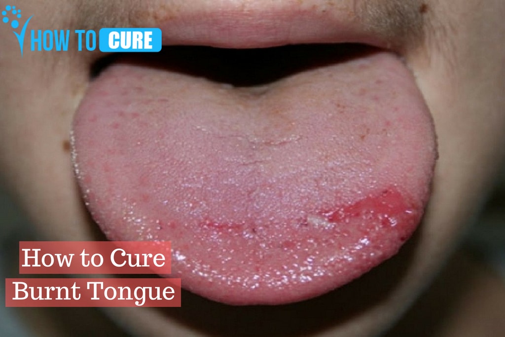 How To Heal A Burnt Tongue? Natural Remedies To Consider | How To Cure