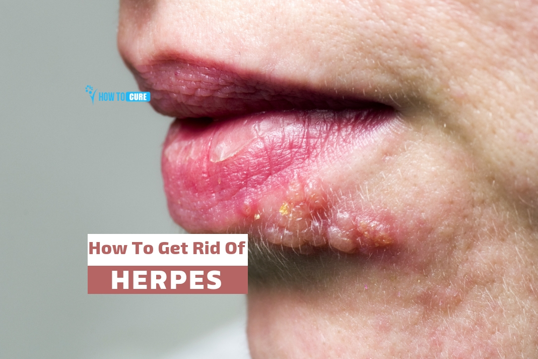 How To Get Rid Of Herpes In 5 Unusual Ways At Home How To Cure