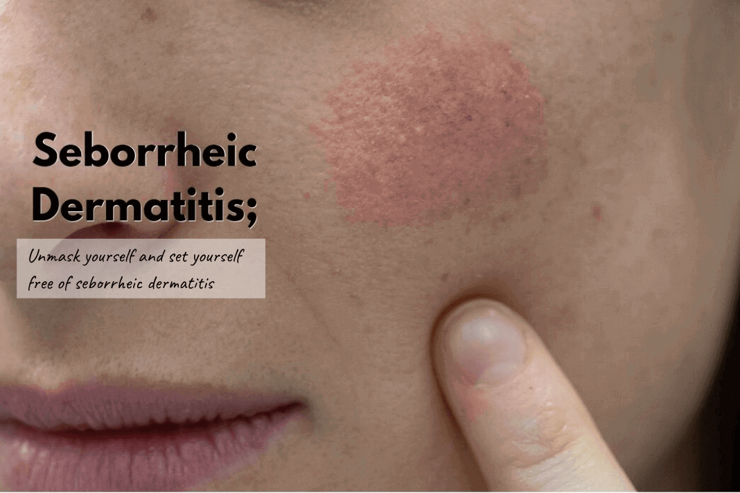 How To Treat Seborrheic Dermatitis Using Natural Treatments How To Cure