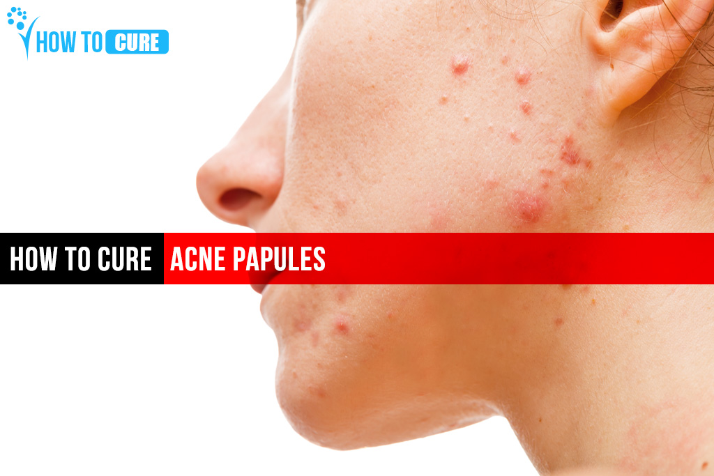 How To Cure Acne Papules.