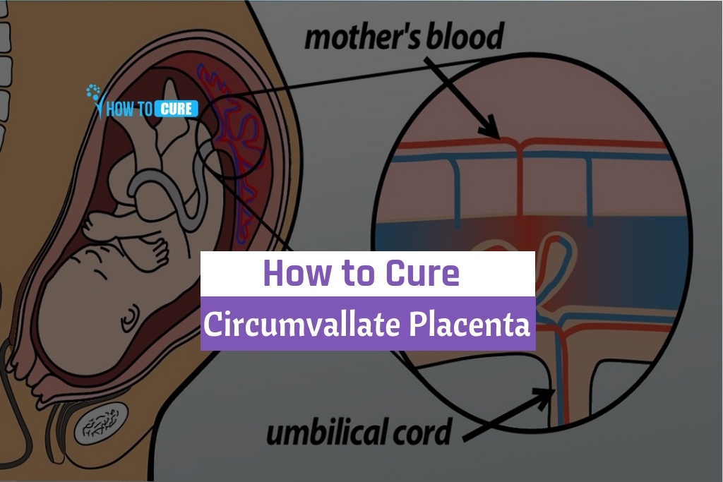 Special Tips To Cure Circumvallate Placenta - Natural ...