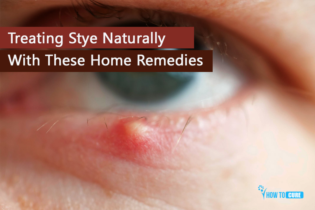 Treating Stye Naturally With These Home Remedies