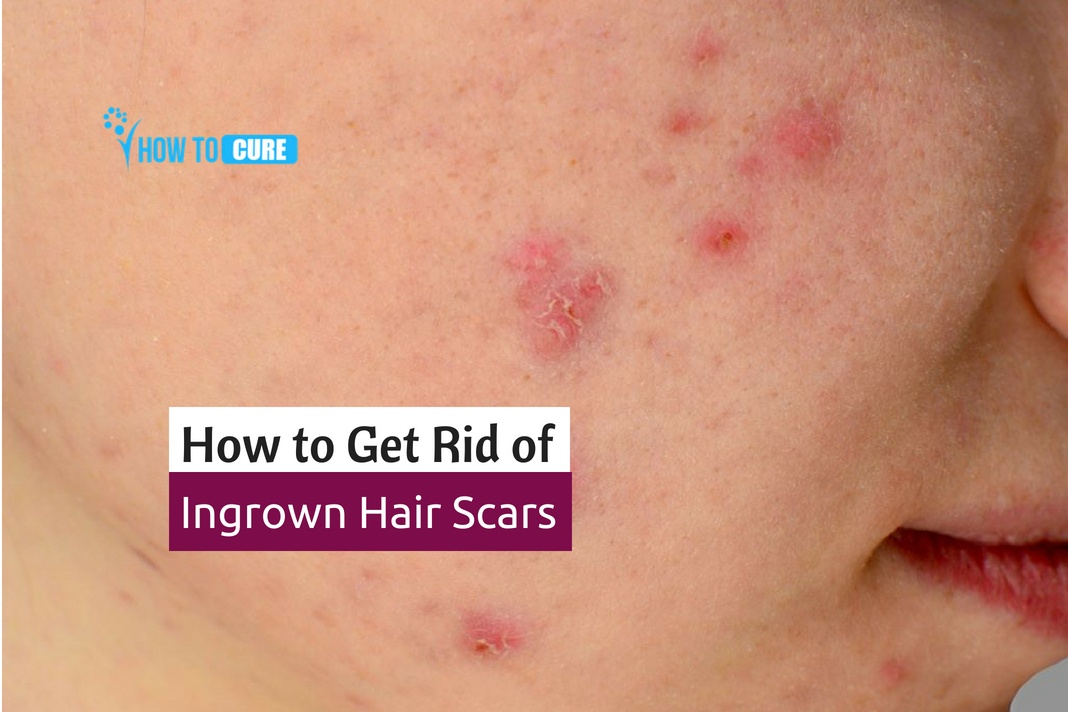get rid of ingrown hair scars