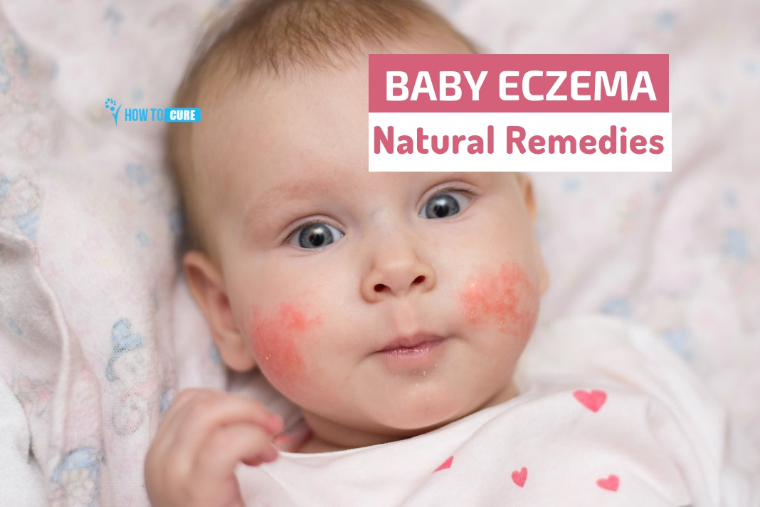 5 Amazing Baby Eczema Natural Remedies That You Must Try