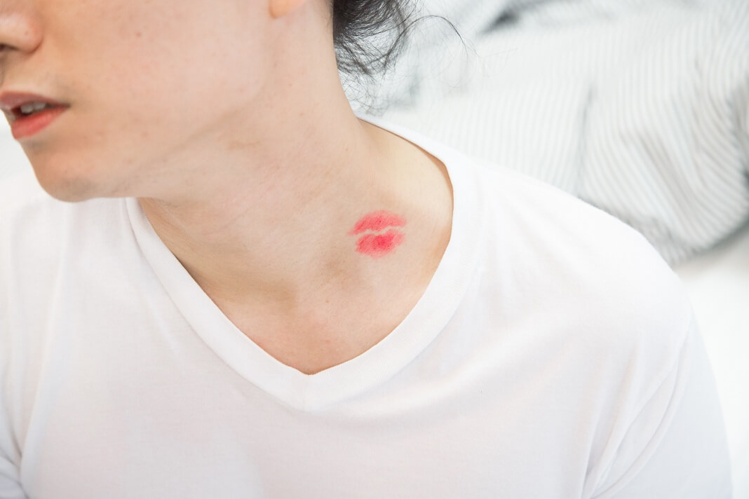 Hickey Is a Type of Bruise Also Referred to as a Kiss Mark or a Love Bite B...