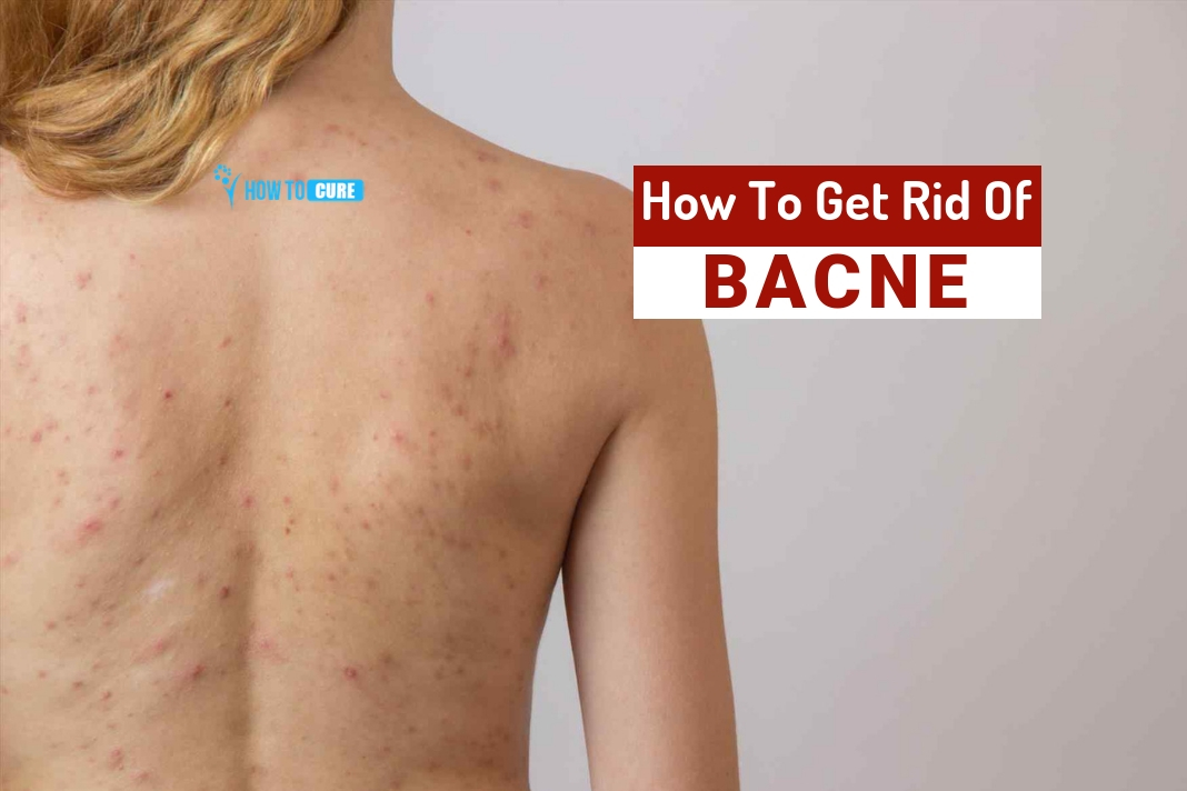 How To Get Rid Of Bacne 5 Natural Ways To Treat Back Acne