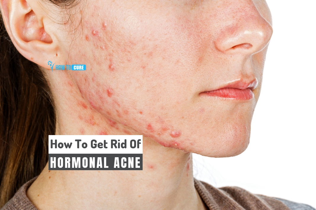 How To Get Rid Of Hormonal Acne In 5 Natural Ways At Home How To Cure 