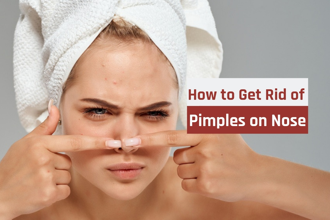 How To Get Rid Of Pimples On The Nose 5 Natural Remedies