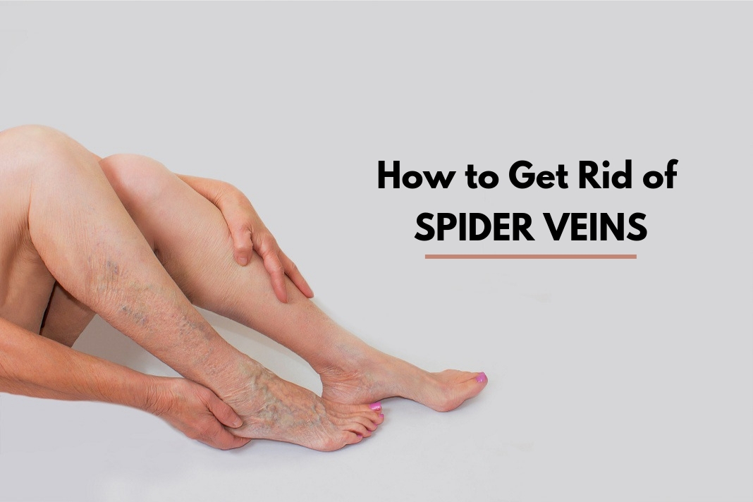 How To Get Rid Of Spider Veins With Top 5 Home Remedies ...