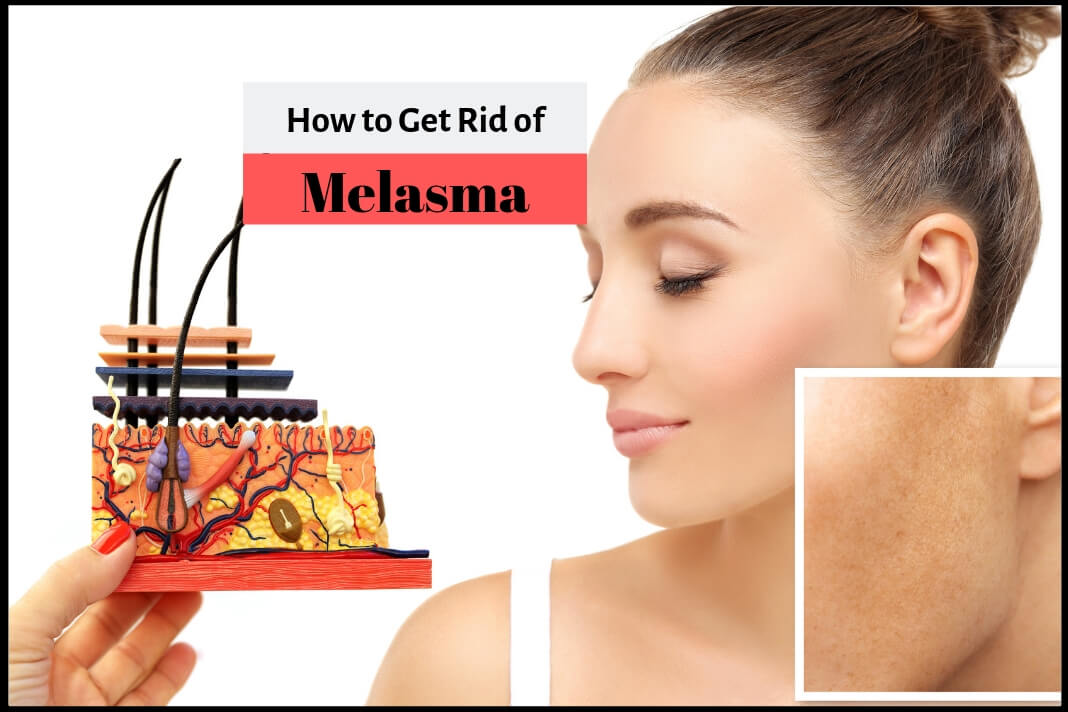 how to reduce melasma